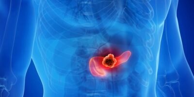 O câncer de pâncreas costuma evoluir de forma silenciosa nos estágios iniciais. — Foto: Reprodução / Redes sociais