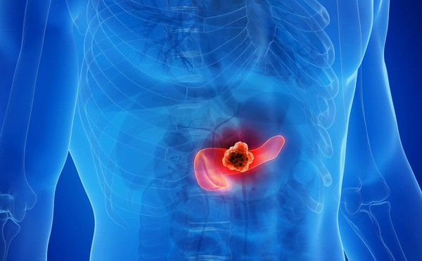 IMG_9274 - Diario do Povo O câncer de pâncreas costuma evoluir de forma silenciosa nos estágios iniciais. — Foto: Reprodução / Redes sociais